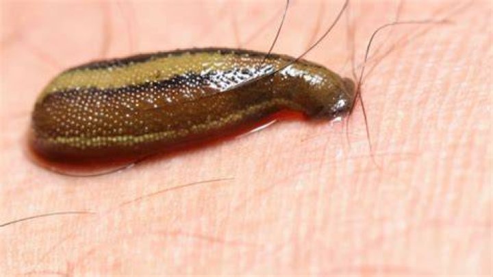 Can a leech survive in your stomach?