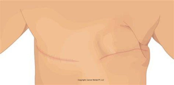 Can breast scar tissue become cancerous?