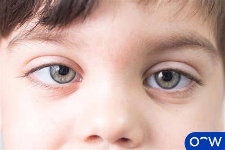 Can lazy eye be treated in age 12?