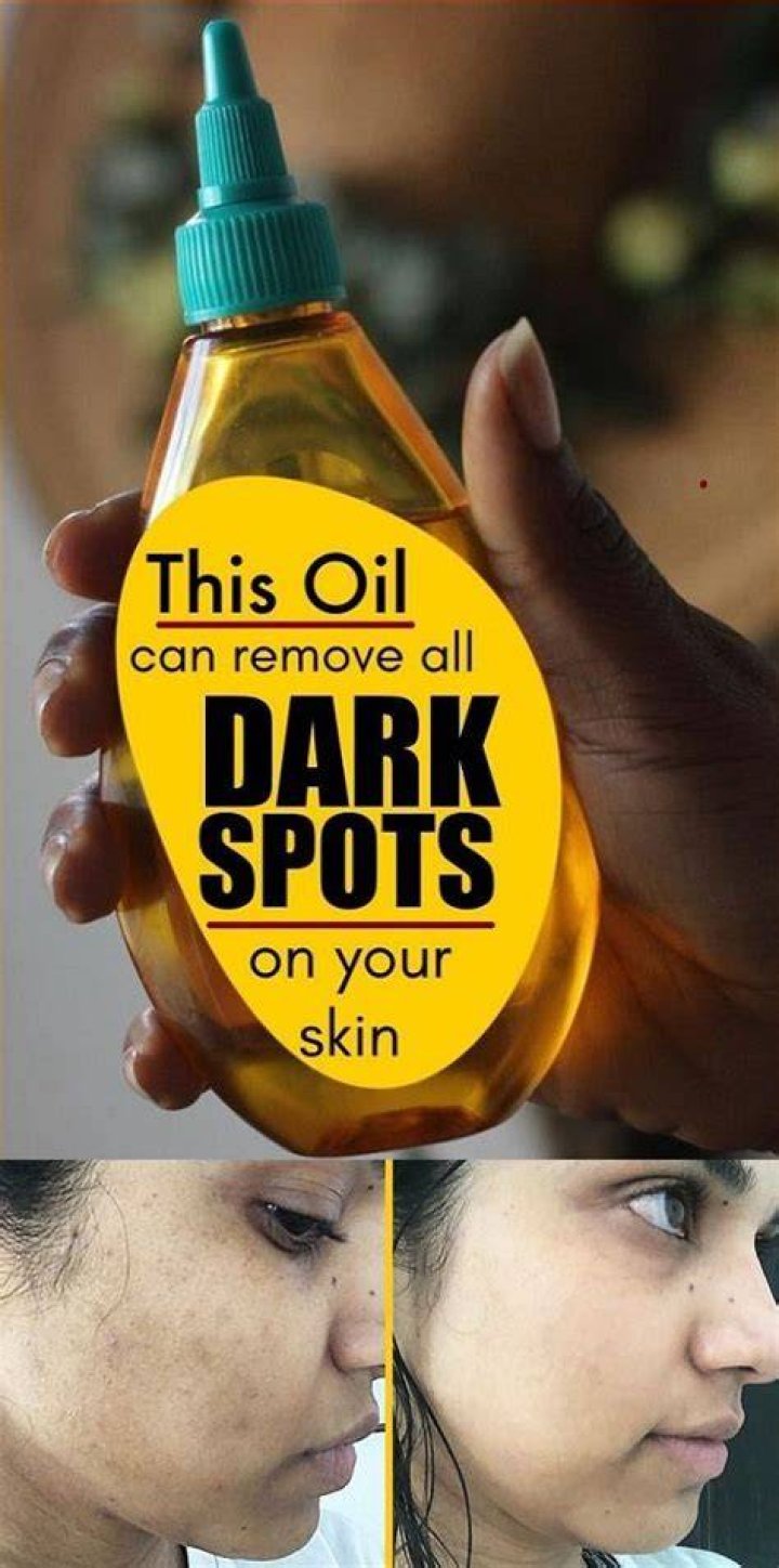 Can olive oil remove dark spots?
