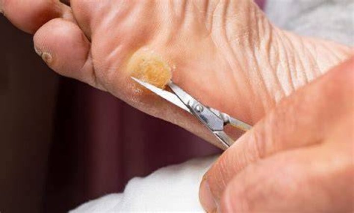 Does cutting calluses make them worse?