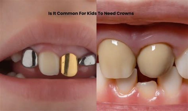 How common is it for kids to have crowns?