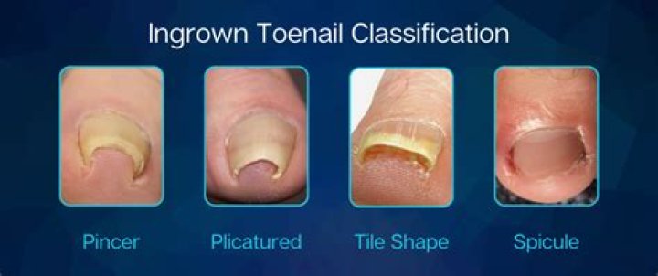 How do you get an ingrown toenail out yourself?