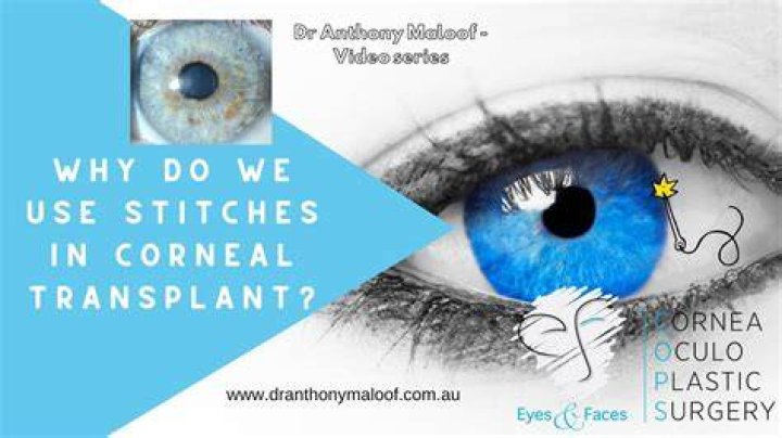 How long do eye stitches stay in?