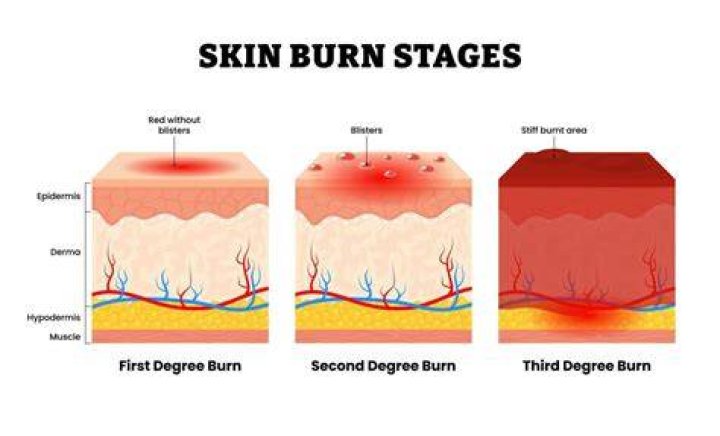 How long does first degree burn pain last?
