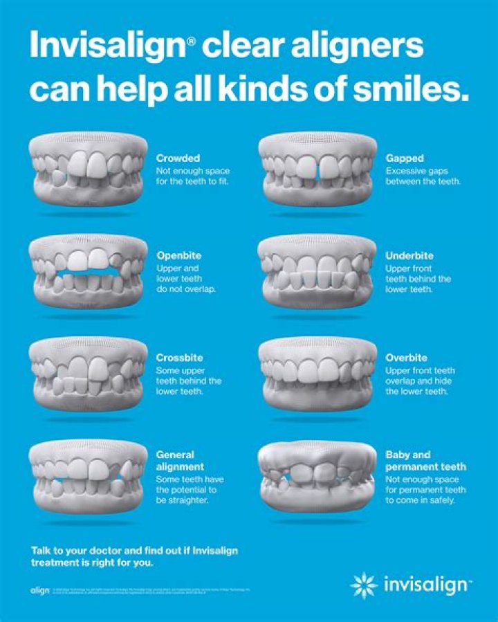 How old do u have to be to get an Invisalign?