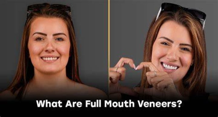 Is it worth getting veneers in Turkey?