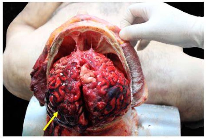Is the skull removed during brain surgery?