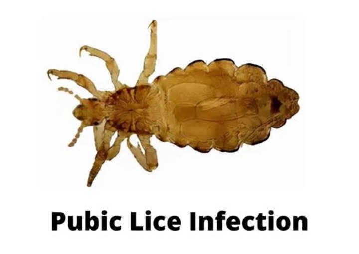 What type of STD is pubic lice?