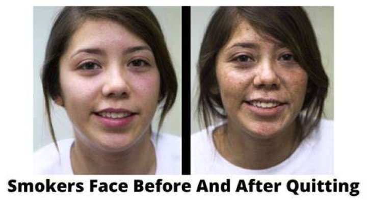 When does skin look better after quitting smoking?