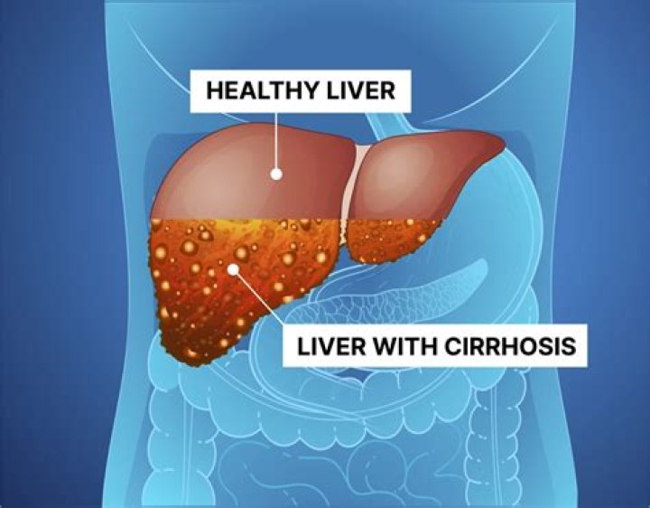 Will they find a cure for cirrhosis?